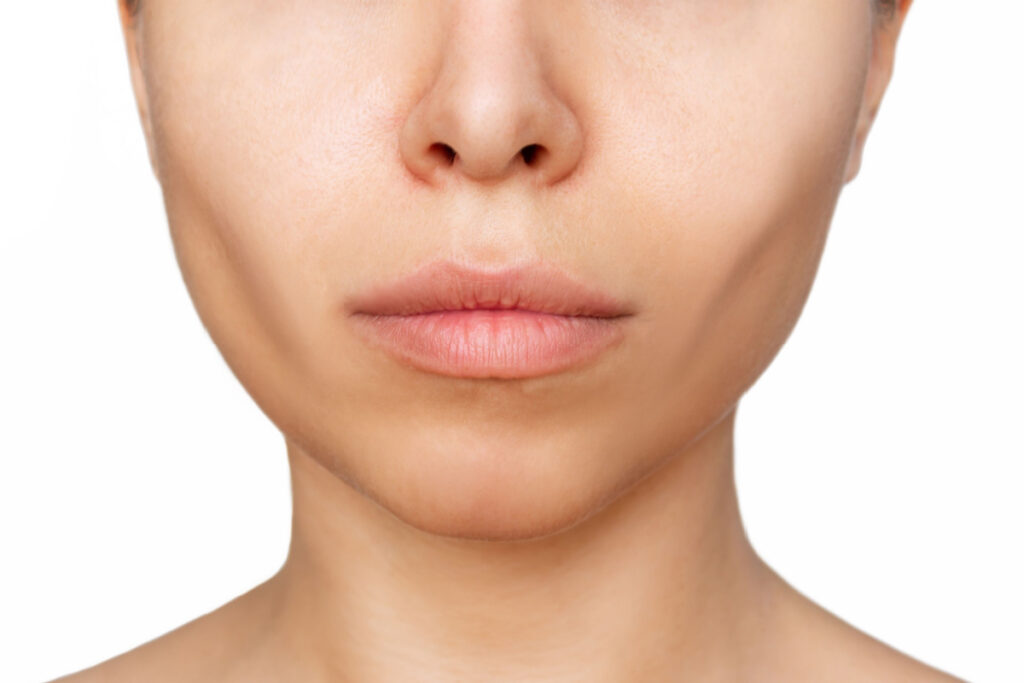 Close-up of a person's lower face post-buccal fat removal, showing enhanced facial definition.