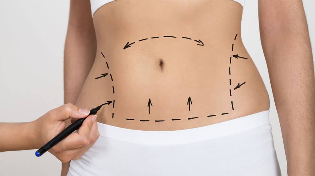 Swelling after tummy tuck — all you need to know