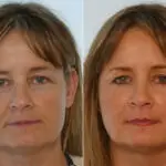 Fillers before and after photos in Houston, TX, Patient 28497