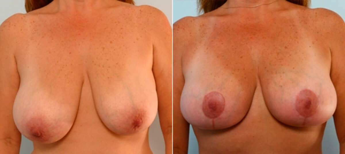 Breast Lift before and after photos in Houston, TX, Patient 27453