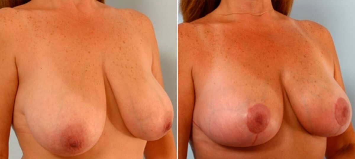 Breast Lift before and after photos in Houston, TX, Patient 27453