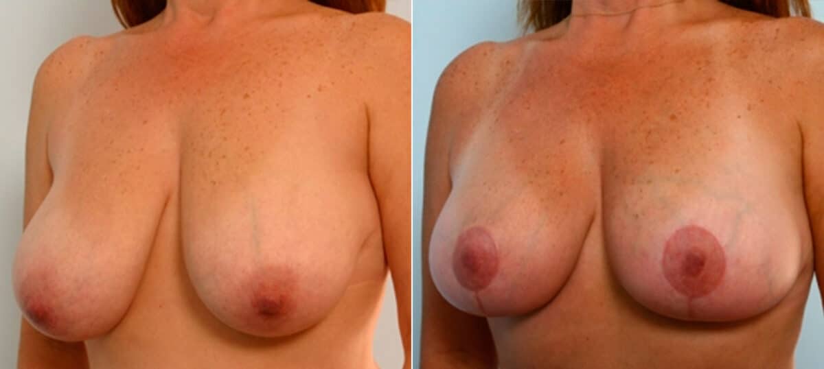 Breast Lift before and after photos in Houston, TX, Patient 27453