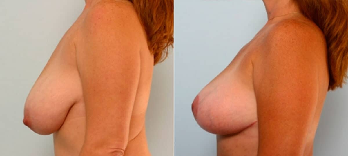 Breast Lift before and after photos in Houston, TX, Patient 27453