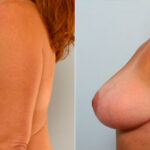 Breast Lift before and after photos in Houston, TX, Patient 27453