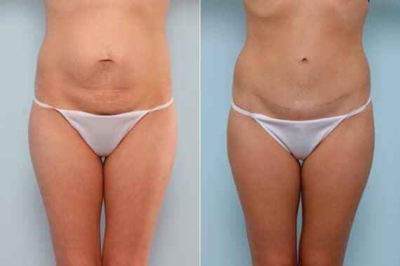 Mommy Makeover before and after photos in Houston, TX, Patient 57553
