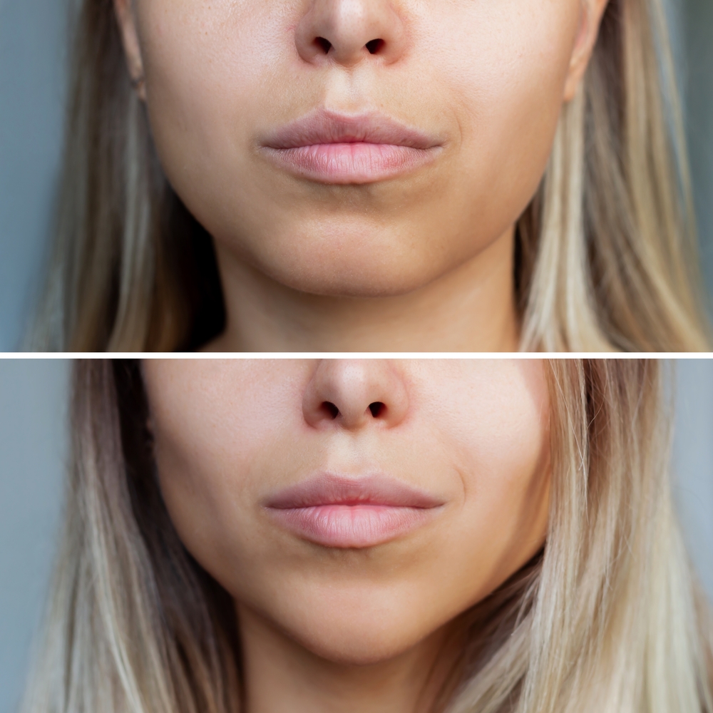 Before and after views of a woman's cheeks, showing buccal fat removal results.