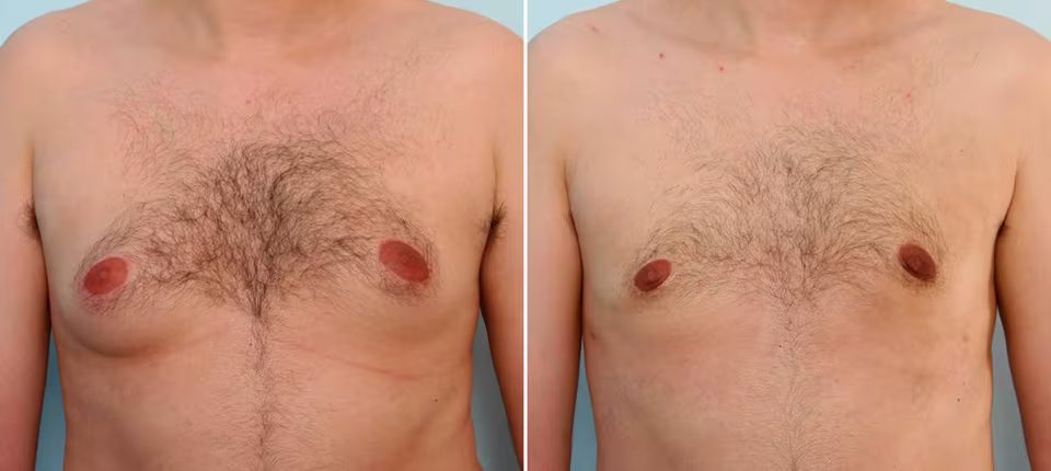 Male Breast Reduction Before & After Photos Patient 1