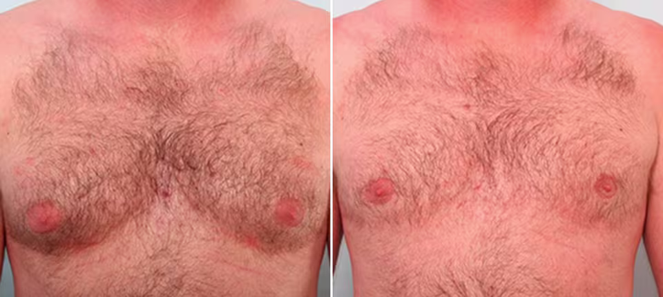 Male Breast Reduction Before & After Photos Patient 4