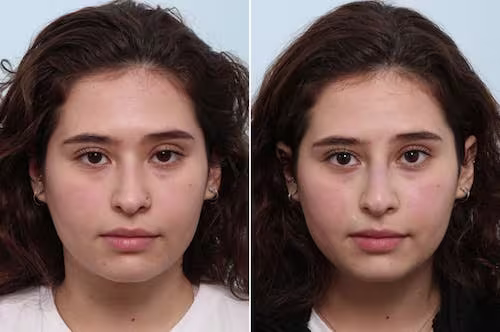 Non-Surgical Rhinoplasty Before & After Photos Patient 3