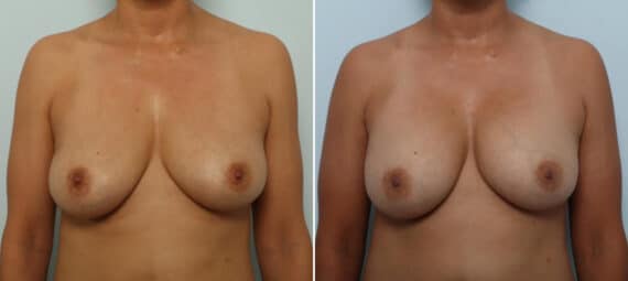 Breast Implant Removal before and after photos in Houston, TX