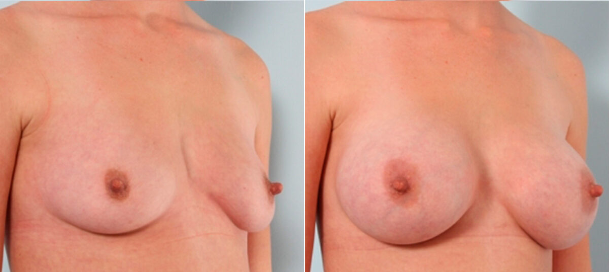 Breast Augmentation before and after photos in Houston, TX, Patient 24688