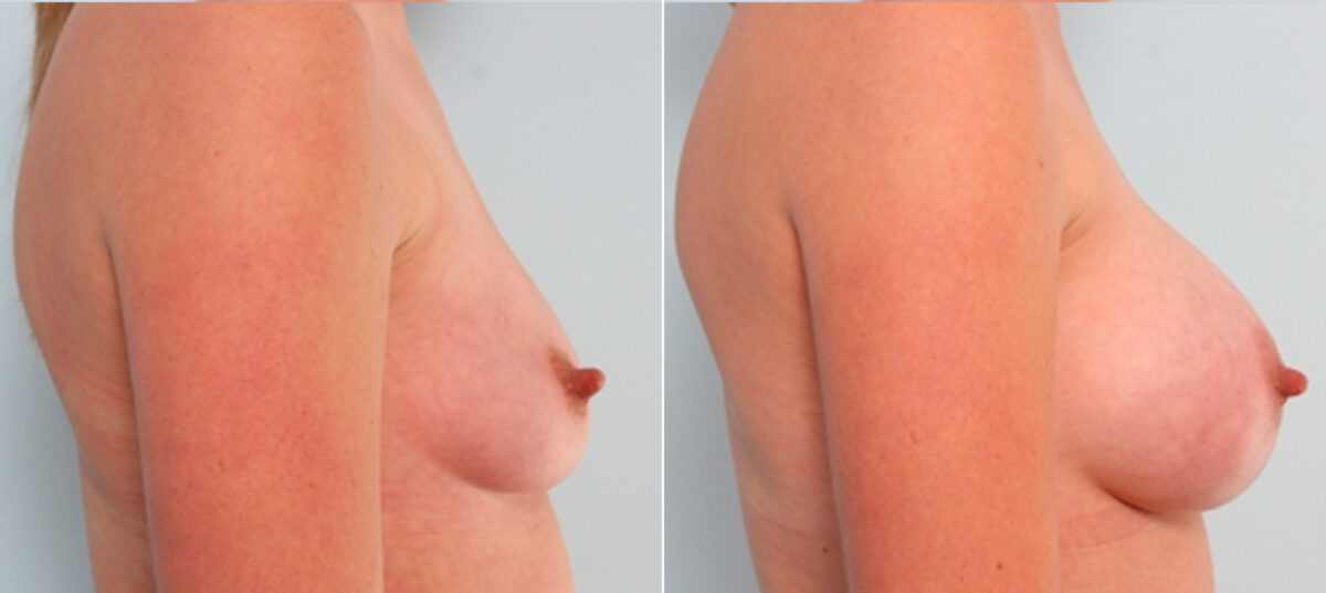 Breast Augmentation before and after photos in Houston, TX, Patient 24688