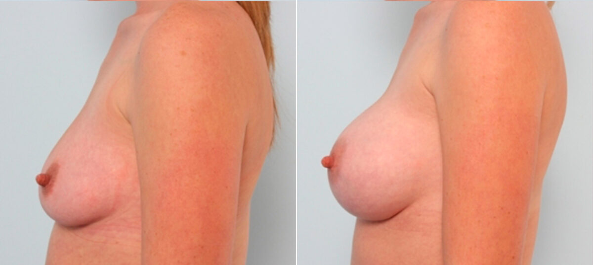 Breast Augmentation before and after photos in Houston, TX, Patient 24688