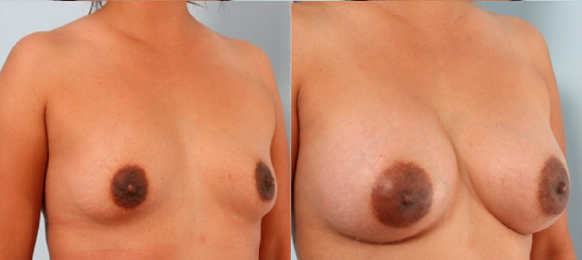 Breast Augmentation before and after photos in Houston, TX, Patient 24732