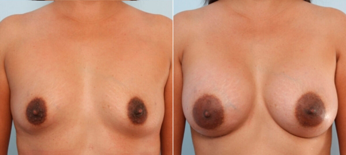 Breast Augmentation before and after photos in Houston, TX, Patient 24732