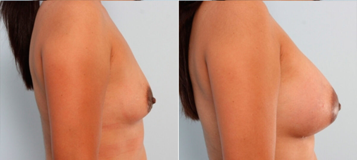 Breast Augmentation before and after photos in Houston, TX, Patient 24732