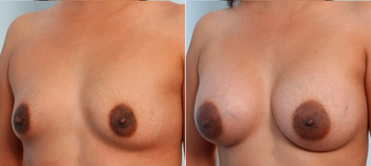 Breast Augmentation before and after photos in Houston, TX, Patient 24732