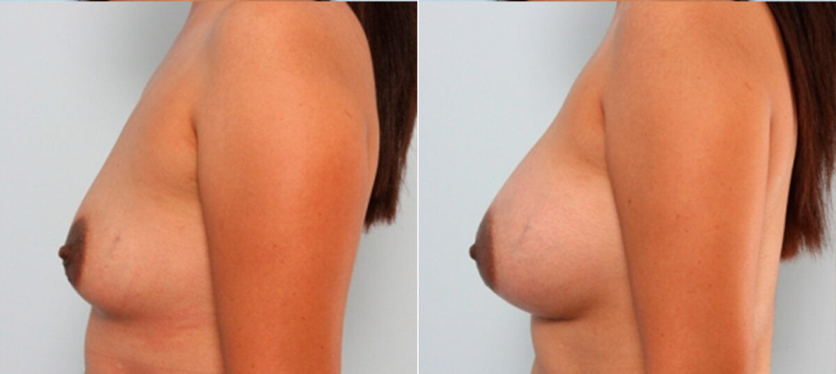 Breast Augmentation before and after photos in Houston, TX, Patient 24732