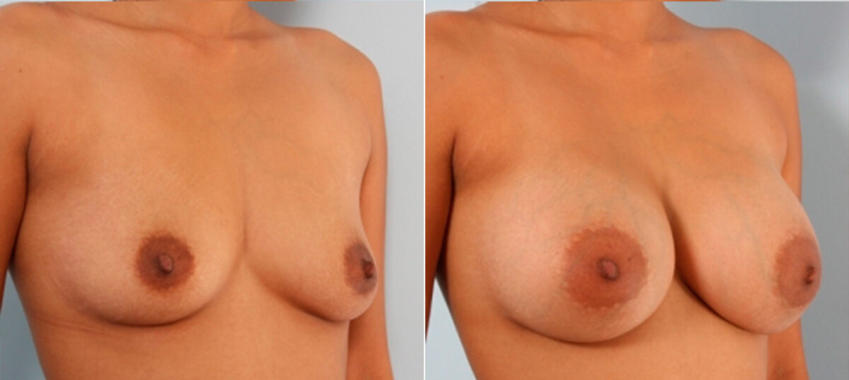 Breast Augmentation before and after photos in Houston, TX, Patient 24743