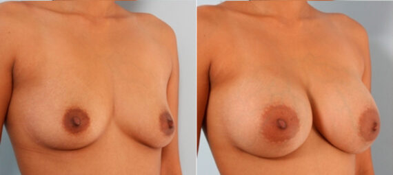 Breast Augmentation before and after photos in Houston, TX, Patient 24743