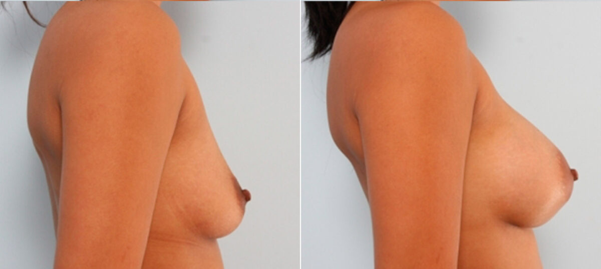 Breast Augmentation before and after photos in Houston, TX, Patient 24743