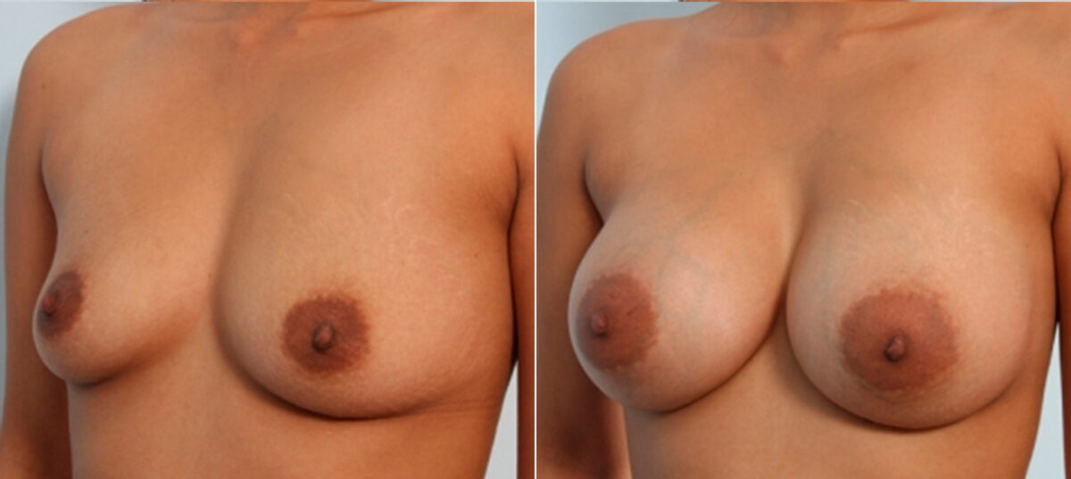 Breast Augmentation before and after photos in Houston, TX, Patient 24743