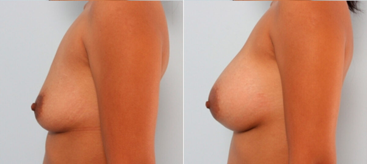 Breast Augmentation before and after photos in Houston, TX, Patient 24743