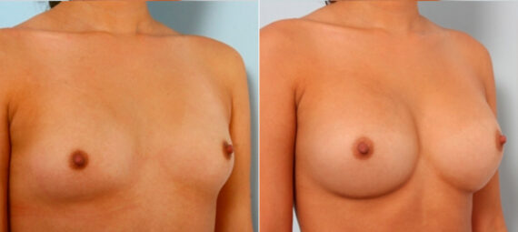 Breast Augmentation before and after photos in Houston, TX, Patient 24754