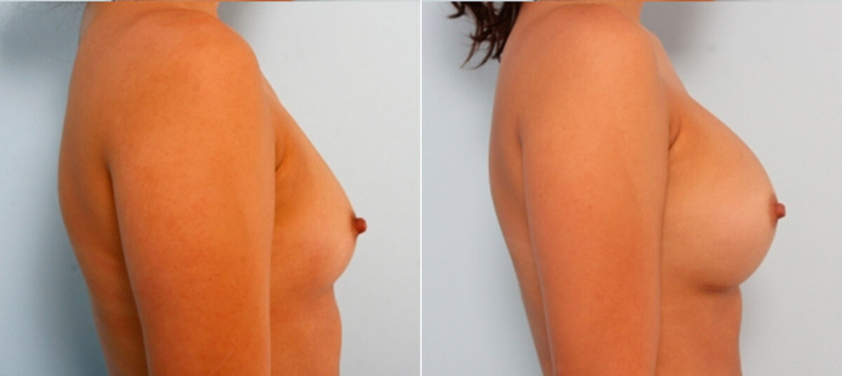 Breast Augmentation before and after photos in Houston, TX, Patient 24754