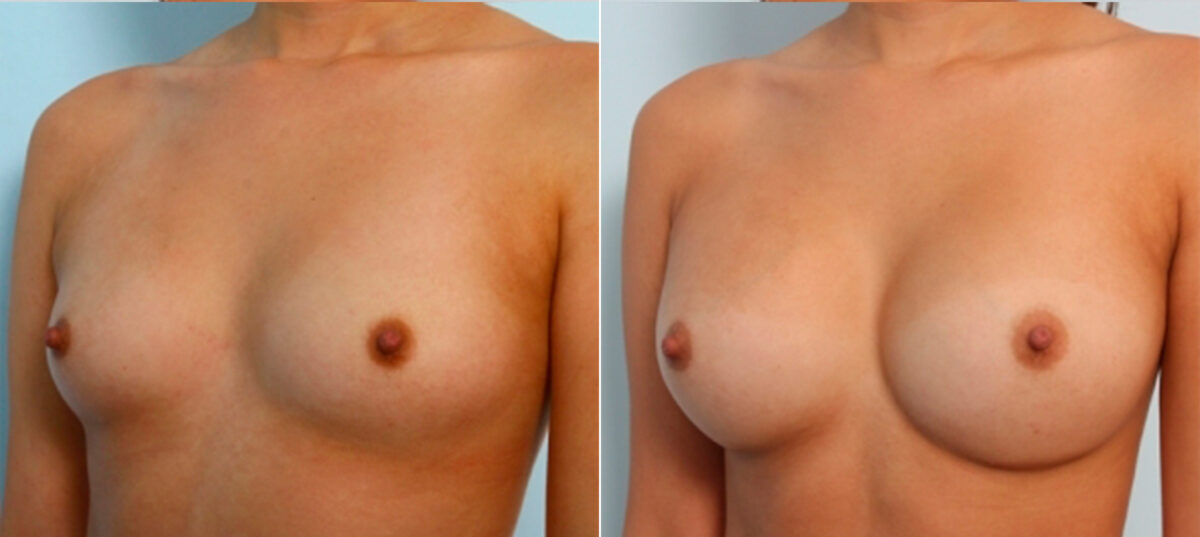 Breast Augmentation before and after photos in Houston, TX, Patient 24754