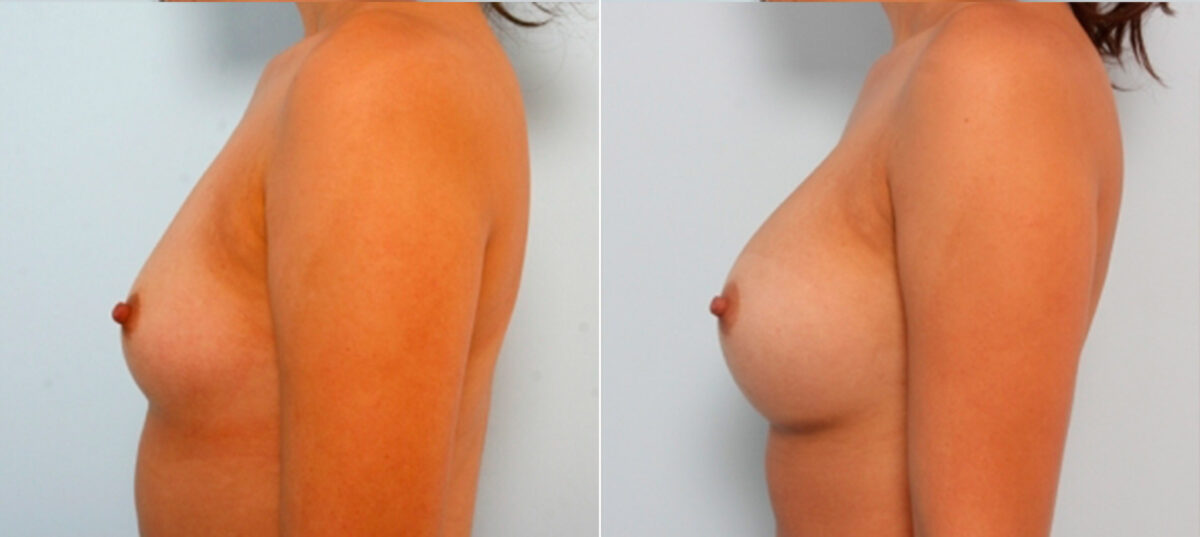Breast Augmentation before and after photos in Houston, TX, Patient 24754