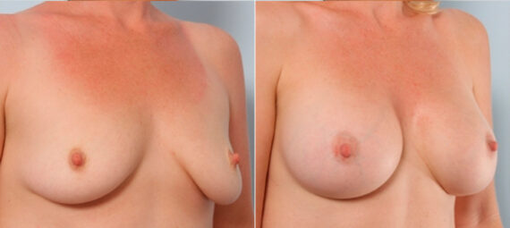 Breast Augmentation before and after photos in Houston, TX, Patient 24776
