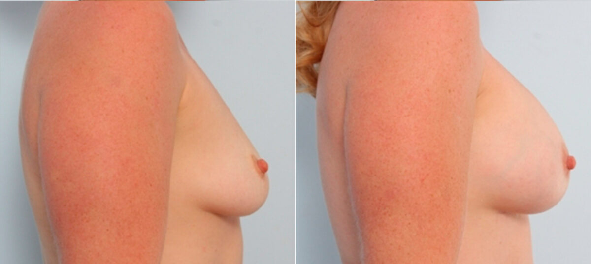Breast Augmentation before and after photos in Houston, TX, Patient 24776