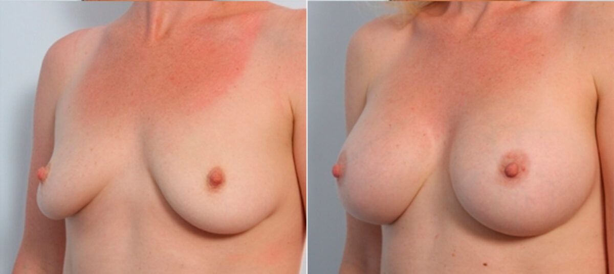 Breast Augmentation before and after photos in Houston, TX, Patient 24776