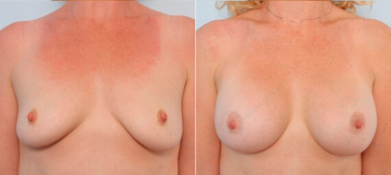 Breast Augmentation before and after photos in Houston, TX, Patient 24776
