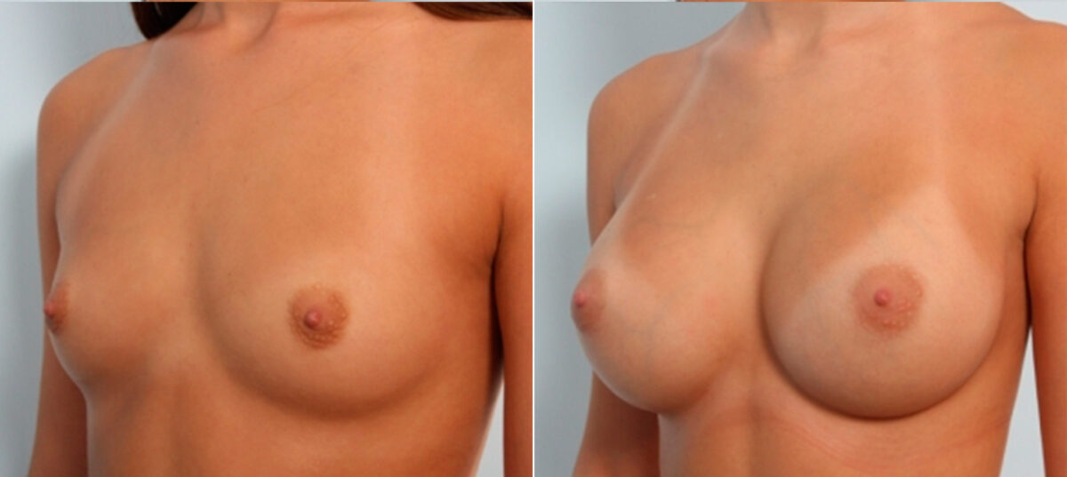 Breast Augmentation before and after photos in Houston, TX, Patient 24787