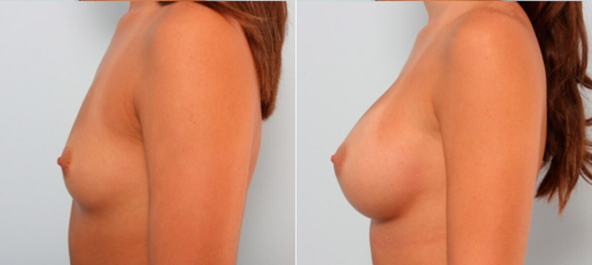 Breast Augmentation before and after photos in Houston, TX, Patient 24787