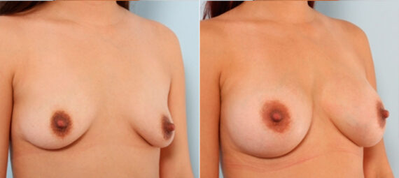 Breast Augmentation before and after photos in Houston, TX, Patient 24798