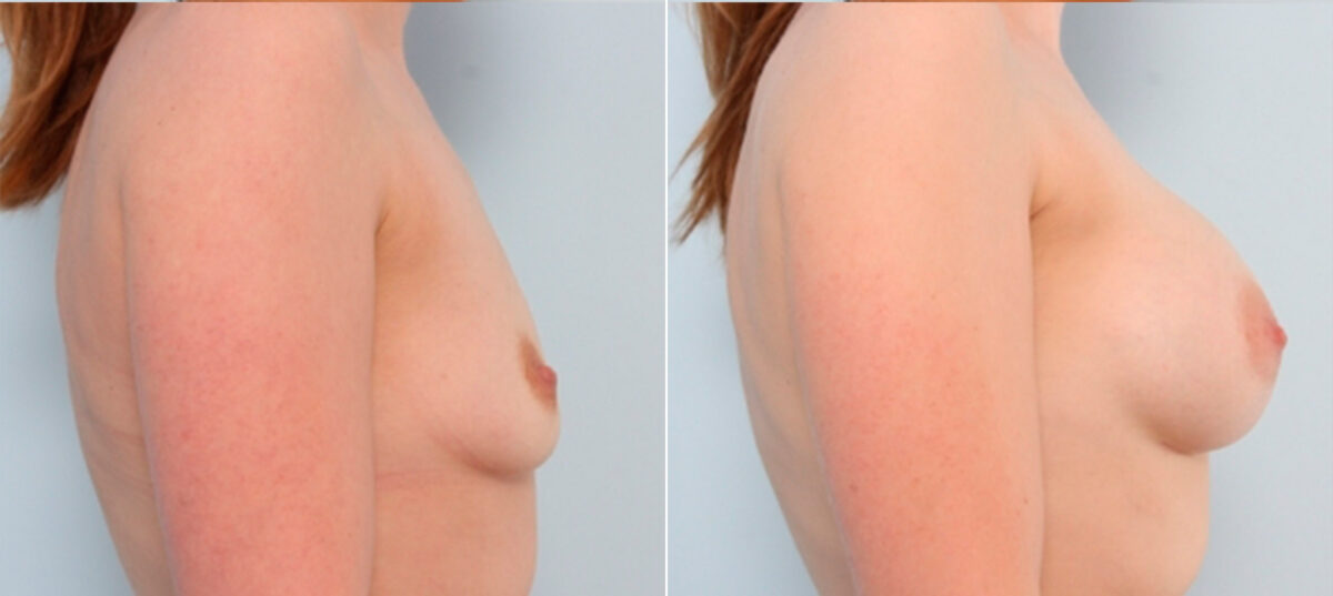 Breast Augmentation before and after photos in Houston, TX, Patient 24809