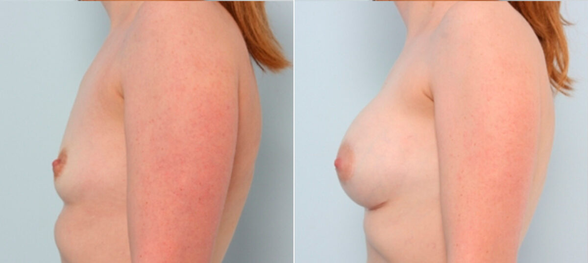 Breast Augmentation before and after photos in Houston, TX, Patient 24809