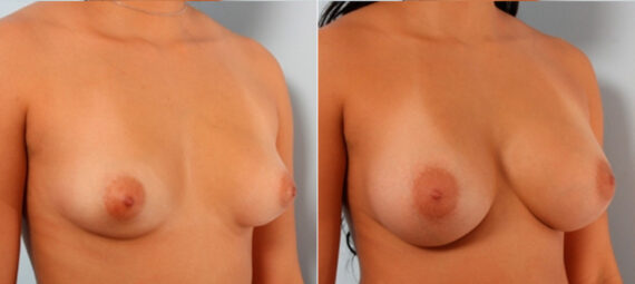 Breast Augmentation before and after photos in Houston, TX, Patient 24820