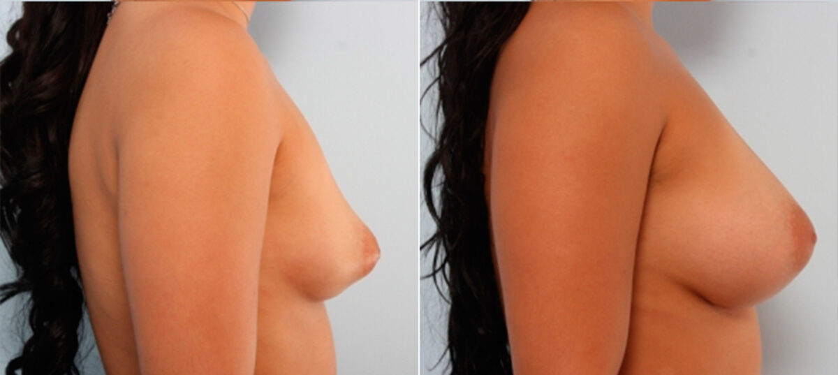 Breast Augmentation before and after photos in Houston, TX, Patient 24820
