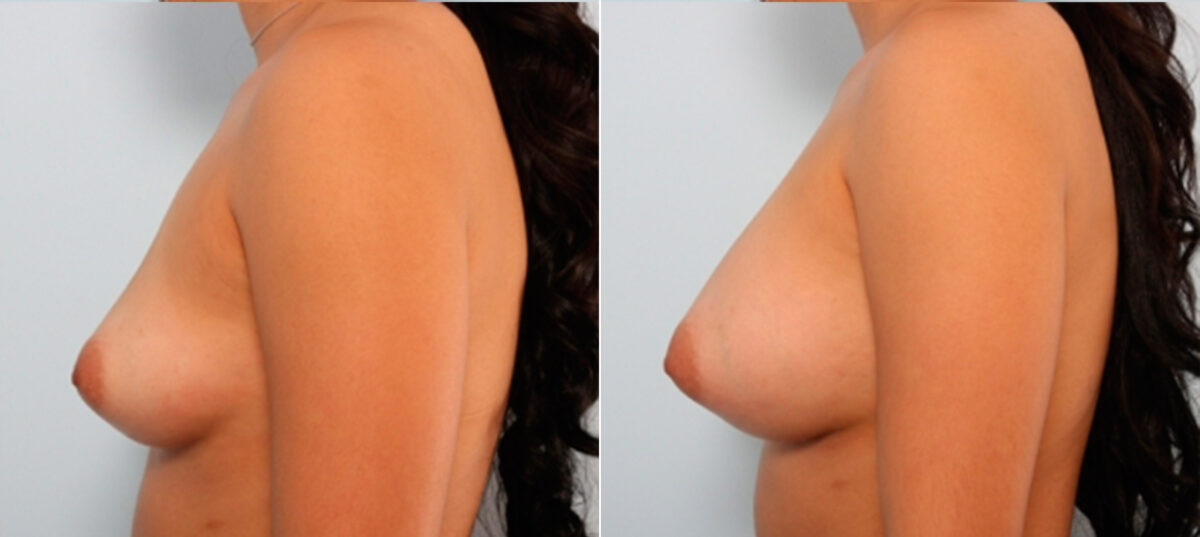 Breast Augmentation before and after photos in Houston, TX, Patient 24820