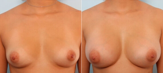 Breast Augmentation before and after photos in Houston, TX, Patient 24820