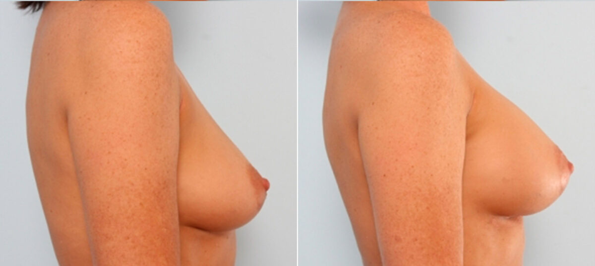 Breast Augmentation before and after photos in Houston, TX, Patient 24831