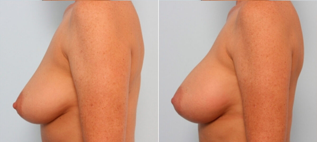 Breast Augmentation before and after photos in Houston, TX, Patient 24831