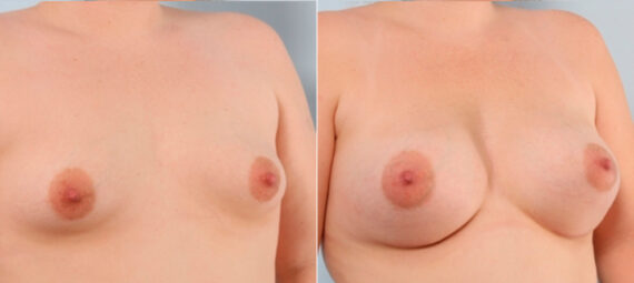 Breast Augmentation before and after photos in Houston, TX, Patient 24853