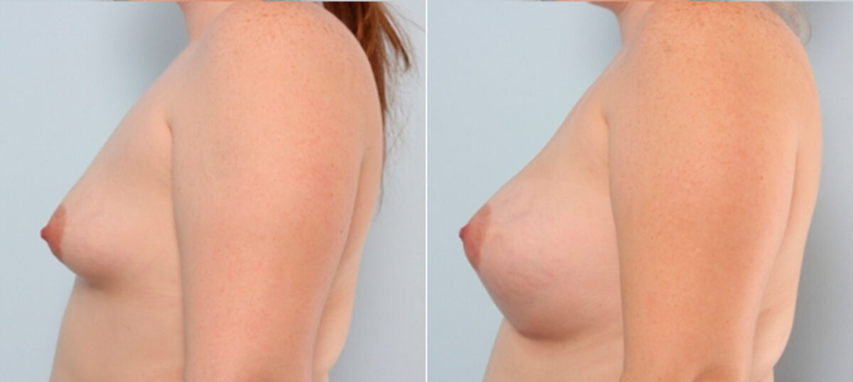 Breast Augmentation before and after photos in Houston, TX, Patient 24853