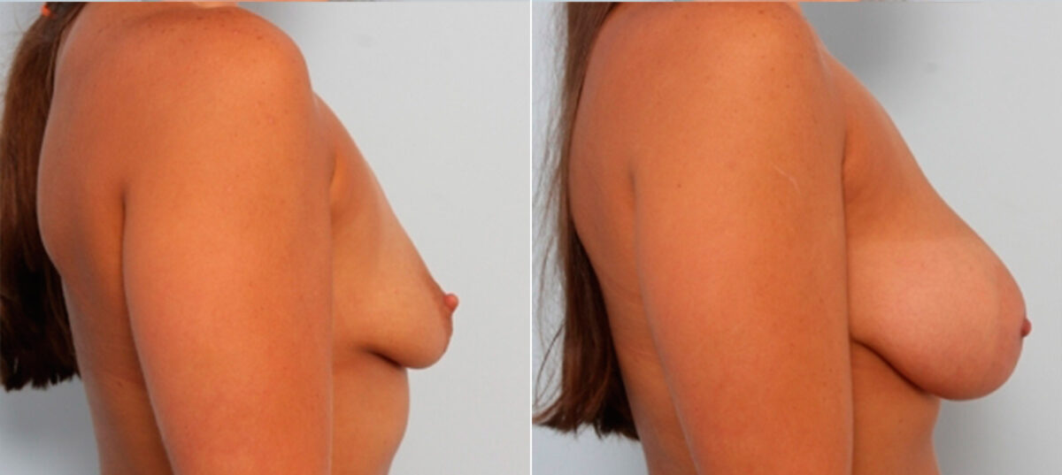Breast Augmentation before and after photos in Houston, TX, Patient 24864