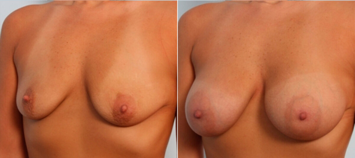 Breast Augmentation before and after photos in Houston, TX, Patient 24864